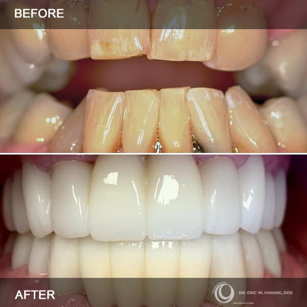 before after cases in exceptional dentistry chandler