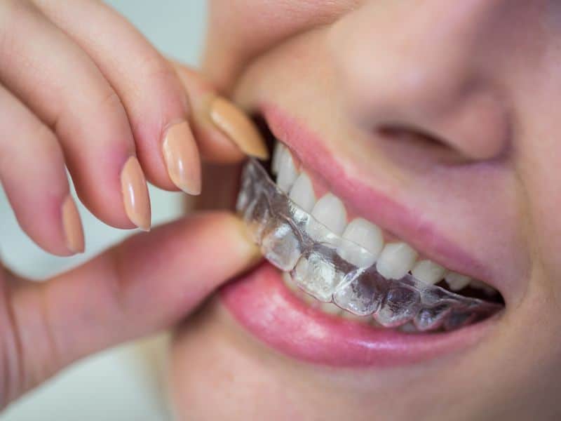 benefits of invisalign-exceptional dentistry chandler