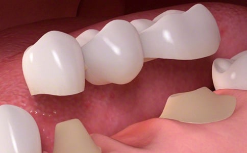 dental bridges