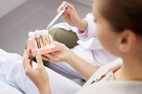 dental implants