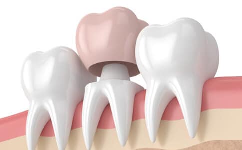 dental crowns