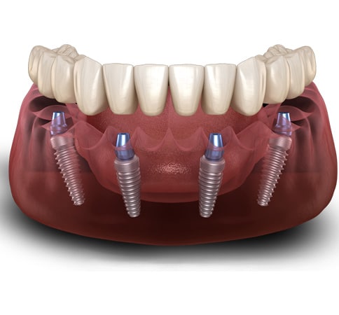 img-how-do-all-on-4-implants-work-exceptional dentistry chandler