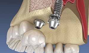  sinus Lift-exceptional dentistry chandler