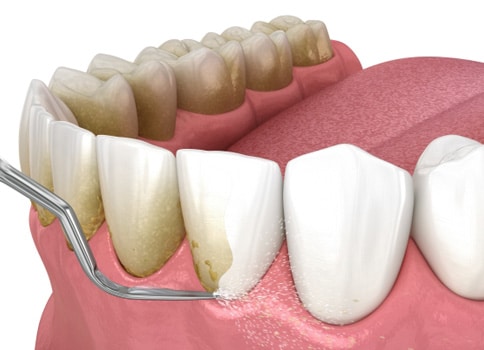 img-scaling-root-planning-exceptional dentistry chandler