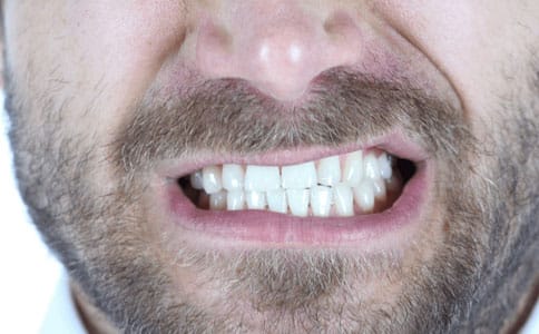 nightguards for bruxism-Exceptional Dentistry Chandler
