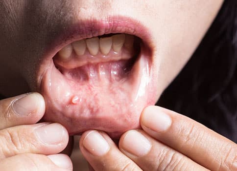 oral cancer screenings-exceptional dentistry chandler