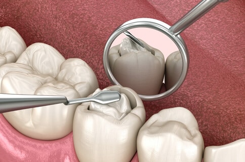 tooth colored filling