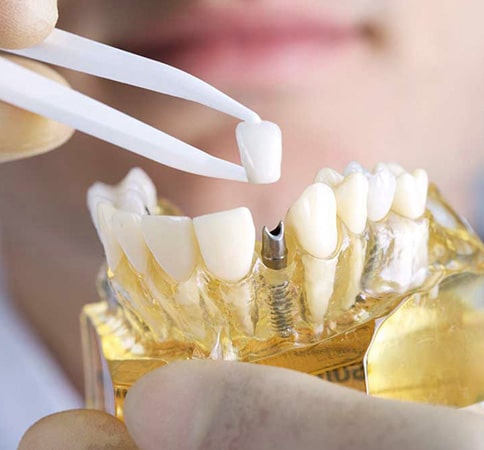 advanced dental implants procedures