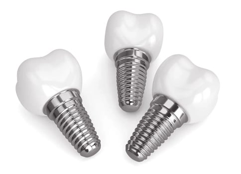 Image of dental implants