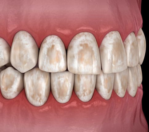 common reasons for tooth extraction-exceptional dentistry chandler