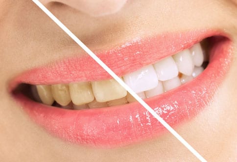 teeth whitening-Exceptional Dentistry Chandler