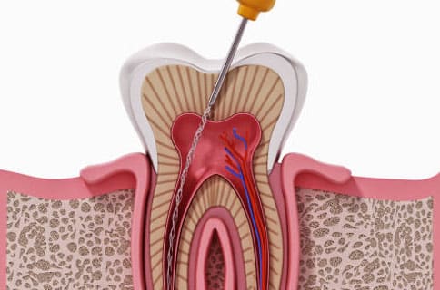 tooth-extraction-work-exceptional dentistry chandler
