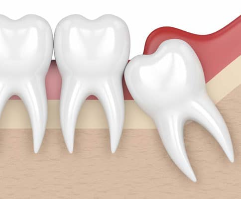 when-is-wisdom-tooth-extraction-really-necessary-exceptional dentistry chandler