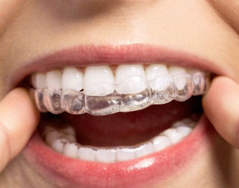 invisalign clear braces-Exceptional Dentistry Chandler