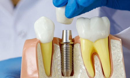 the image of missing one tooth