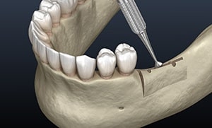 Ridge-Expansion-Exceptional-Dentistry-Chandler