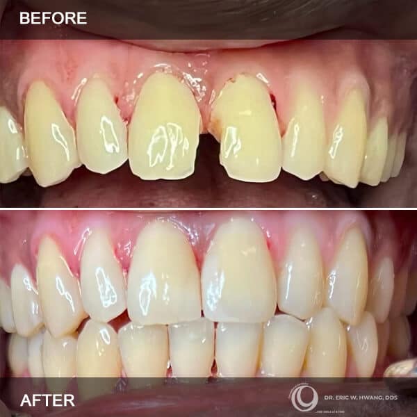 before after cases in exceptional dentistry chandler