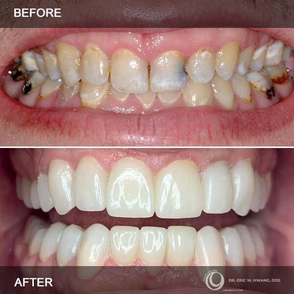 before after cases in exceptional dentistry chandler
