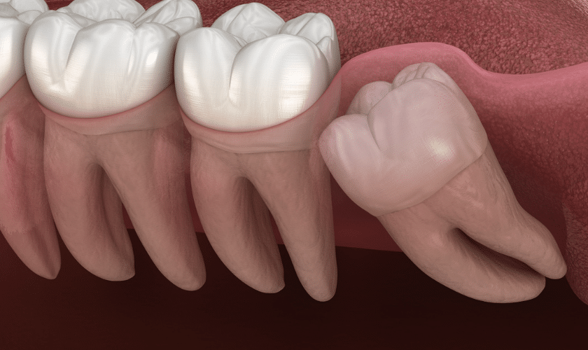 Featured image for “How Wisdom Teeth Removal Can Impact Your Oral Health?”
