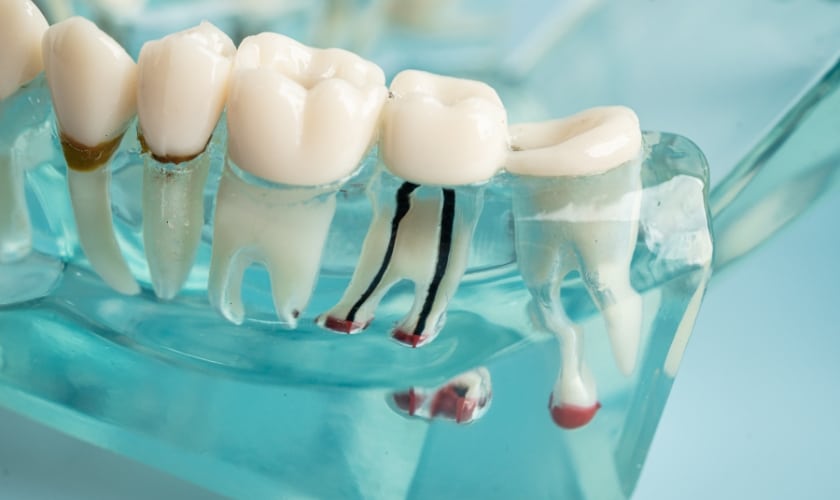 Featured image for “Can a Root Canal Save Your Natural Tooth? Here’s the Truth”